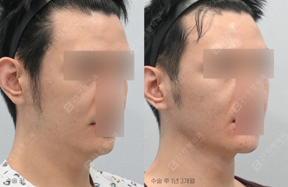 Have You Regretted Having Only Double-Chin Liposuction? Why Muscle Tightening May Be Needed for Successful Double-Chin Surgery image 4