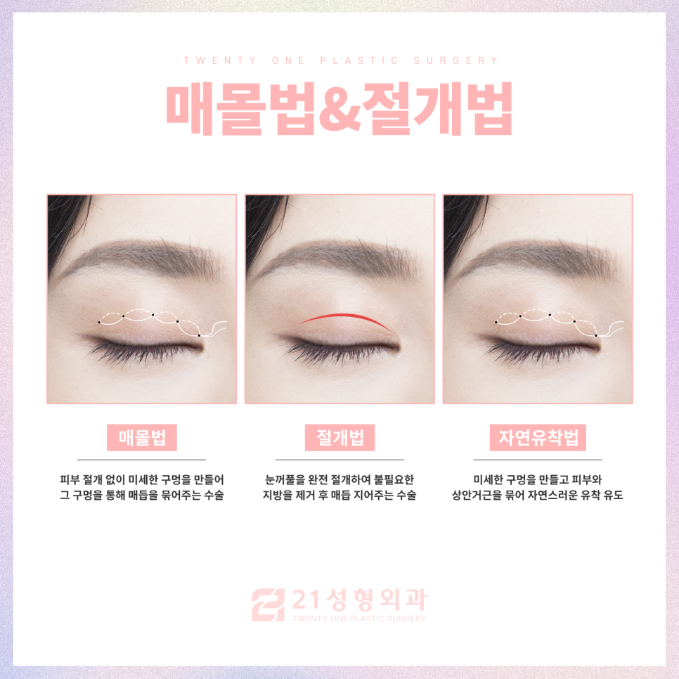강남눈성형잘하는곳 차이점은 관련 이미지 4