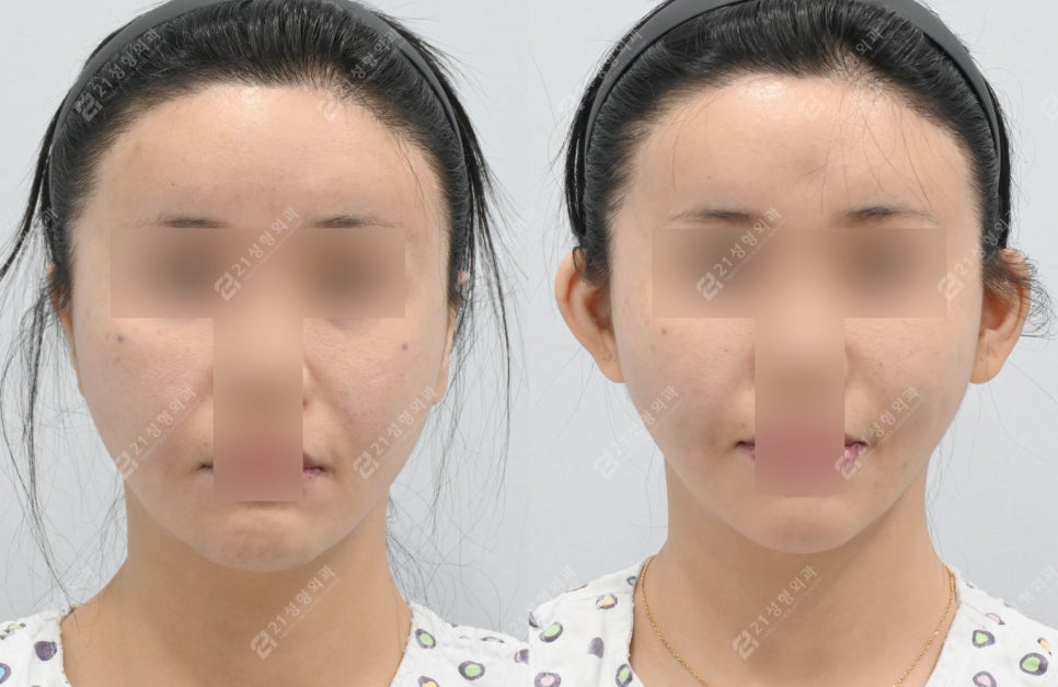 Fae Ear Filler Progress Before and After 3 Months image 2