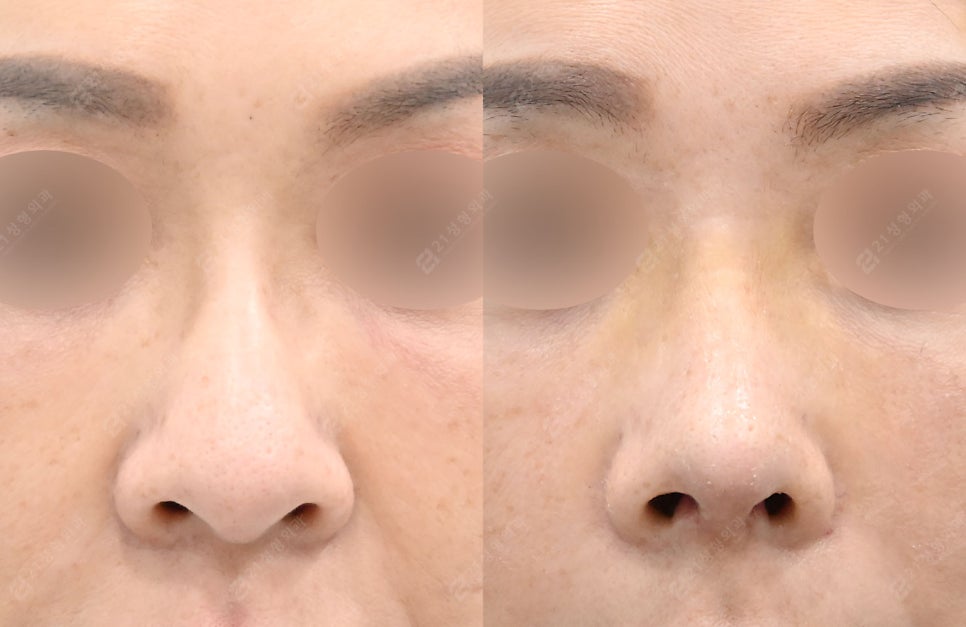 A Real Nose Surgery Review That Combines Safety and Naturalness image 5