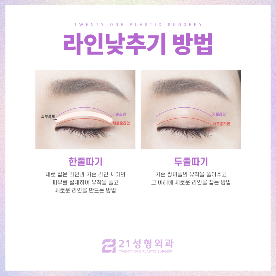 라인낮추기 쌍꺼풀의 자연스러움을 고려하여 관련 이미지 4