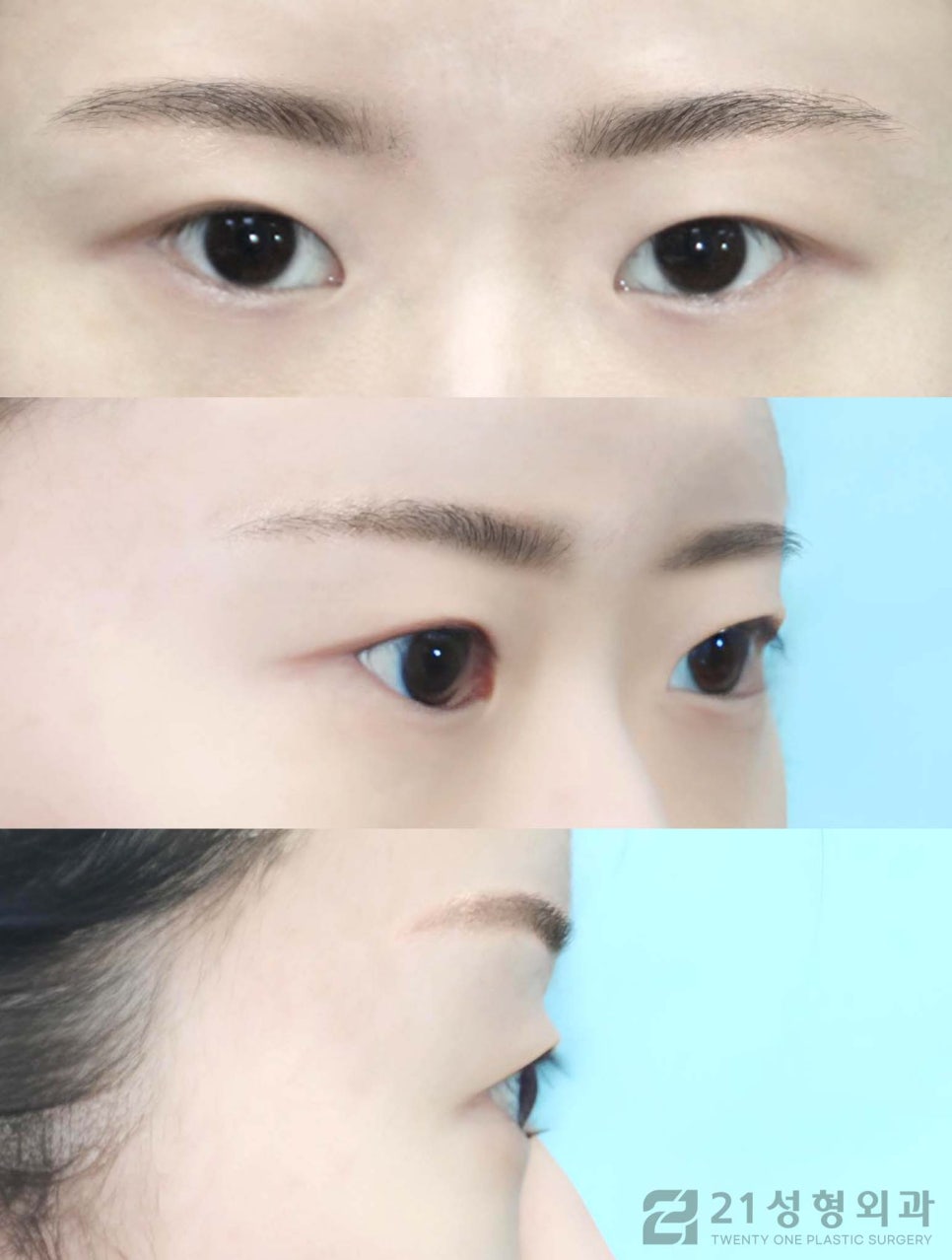 절개쌍수 특징적인 점에 대하여 관련 이미지 5