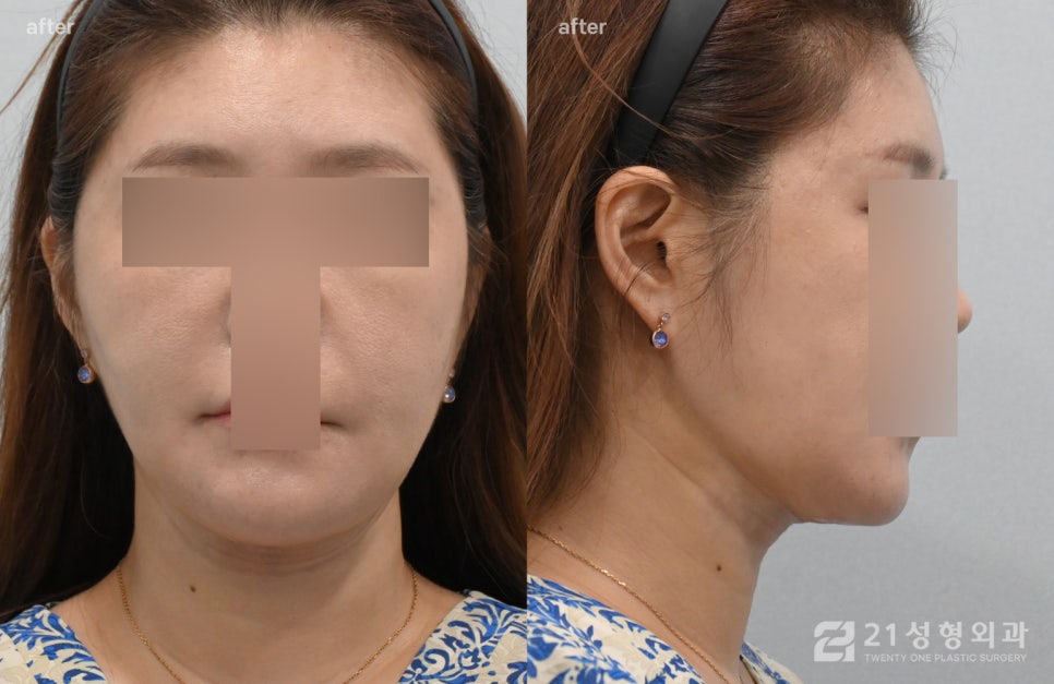 이중턱수술 실제 환자 사례, 지방 흡입부터 근육묶기까지 총정리 관련 이미지 5