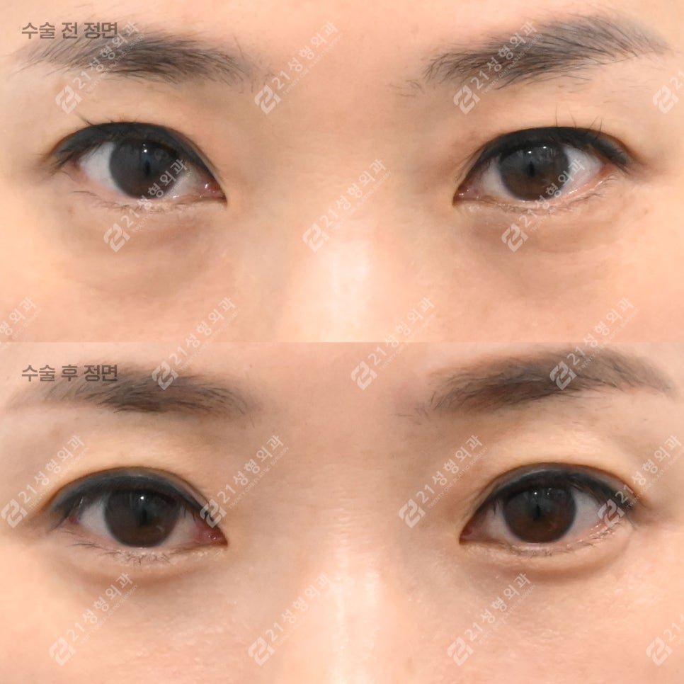 피곤해 보이던 40대 눈밑, 하안검 후 이렇게 달라졌습니다 관련 이미지 1