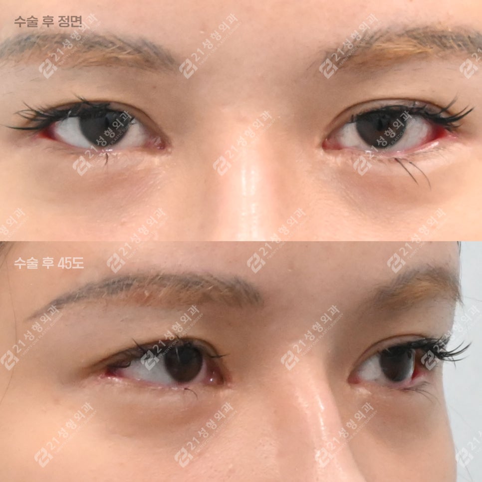 The Reason Lower Eyelid Fat Repositioning Is Needed, Explained Through the Structure Under the Eyes image 2