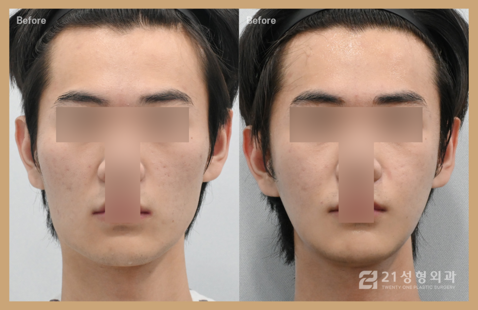 심부볼수술로 윤곽 효과 3배 관련 이미지 1