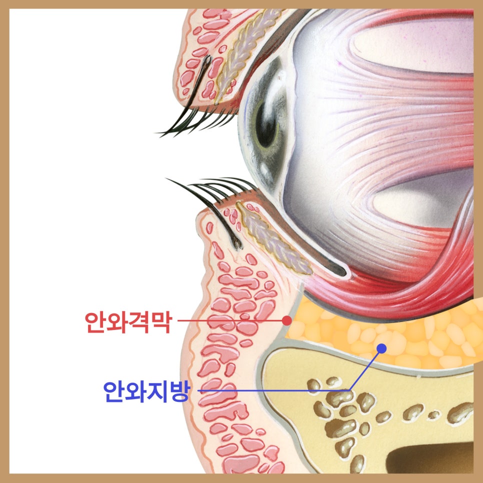 중년하안검 흉터 미리 방지 가능합니다 관련 이미지 2