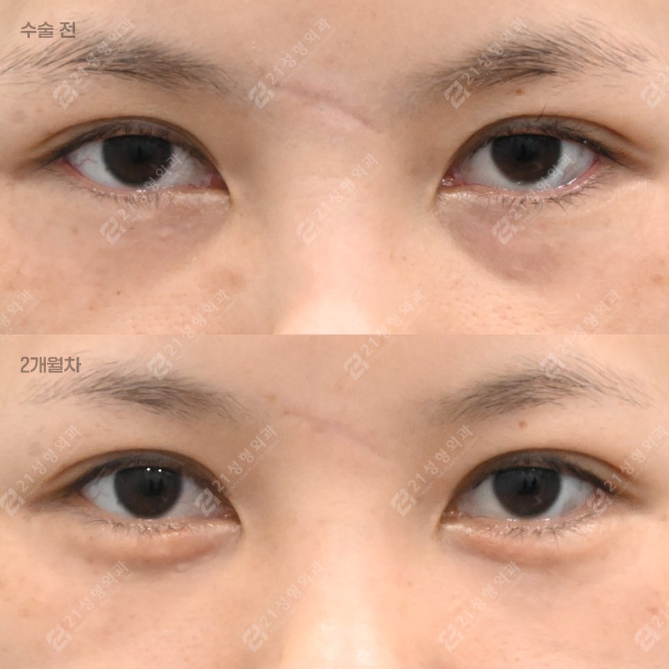 눈밑지방, 무조건 빼면 안 되는 이유 &ndash; 21성형외과 관련 이미지 1