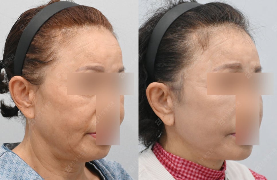 Let’s Address Facial Sagging from the Root Cause! Real Changes from a Face and Neck Lift image 5