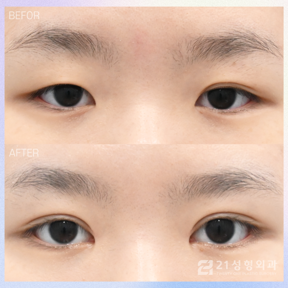 강남성형외과쌍꺼풀을 고민 중이라면 관련 이미지 1