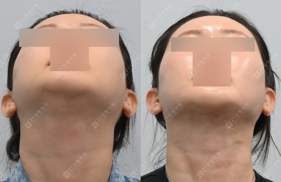 이중턱 지방흡입 받았는데 왜 그대로일까요? 관련 이미지 2