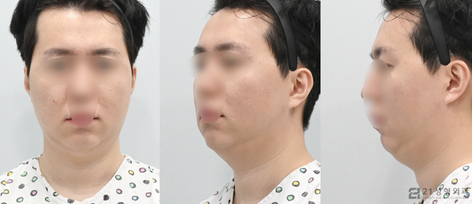 이중턱살빼는방법 갸름한 얼굴라인 비결 관련 이미지 4