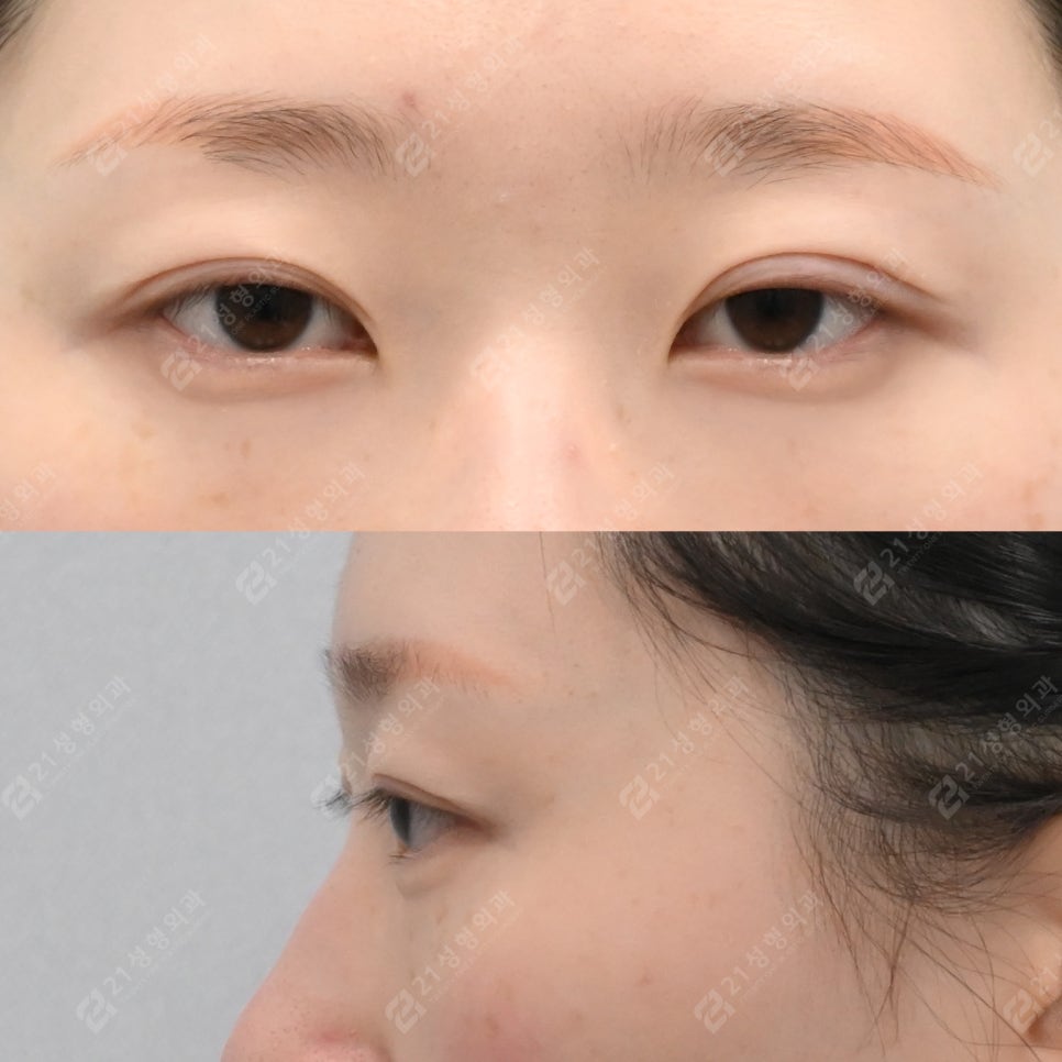 Recovery Period Before and After Lower Eyelid Fat Repositioning image 4