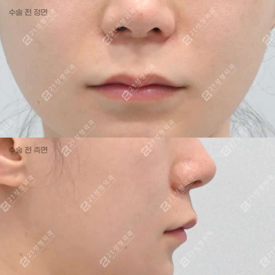 Lip Lift Review | What Matters More Than Length Is Facial Proportion! image 2