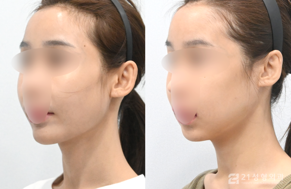 사각턱수술잘하는곳 정보를 알고 싶다면 관련 이미지 2