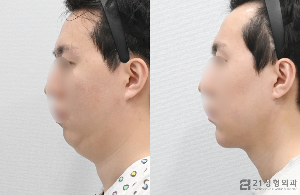 이중턱살빼는방법 갸름한 얼굴라인 비결 관련 이미지 3