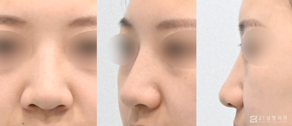 코성형잘하는곳 개인에게 맞는 자연스러운 비율 관련 이미지 4