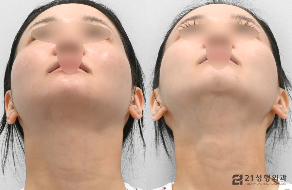 얼굴자가지방이식수술 유지기간과 효과 관련 이미지 4