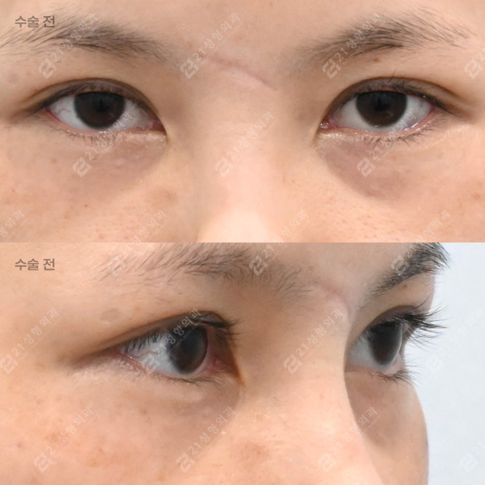 눈밑지방, 무조건 빼면 안 되는 이유 &ndash; 21성형외과 관련 이미지 2