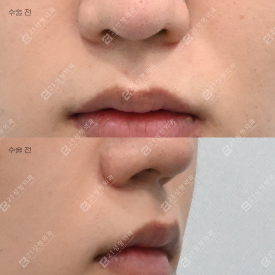 I Almost Gave Up Thinking My Long Philtrum Was Genetic—Until I Finally Looked Into 21 Plastic Surgery image 5