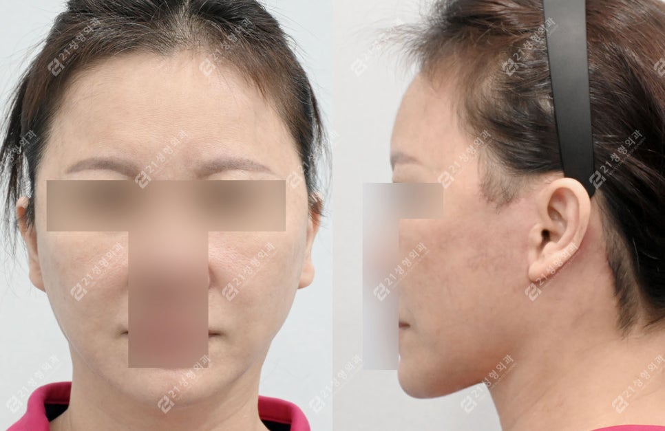 A Face That Needed a Lift, Not a Thread Lift — and There Was a Reason image 4