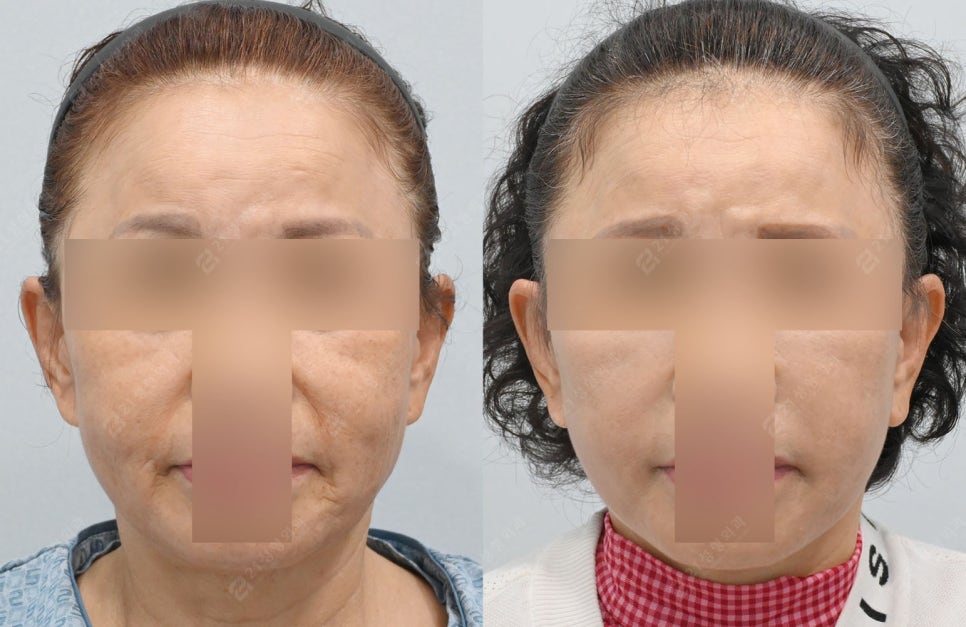 Let’s Address Facial Sagging from the Root Cause! Real Changes from a Face and Neck Lift image 1