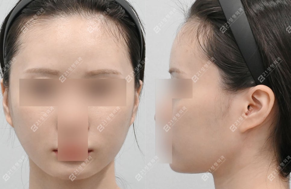 The Reason a Double Chin Appeared After Surgery Was Not a Fat Problem image 4
