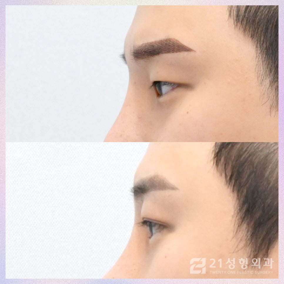 남자눈성형외과 결정에서 가장 중요한 핵심은 관련 이미지 5