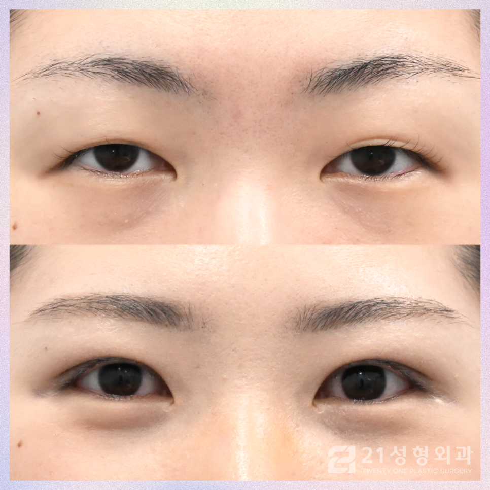 강남눈매교정잘하는곳 성공적인 결과를 위해 관련 이미지 1