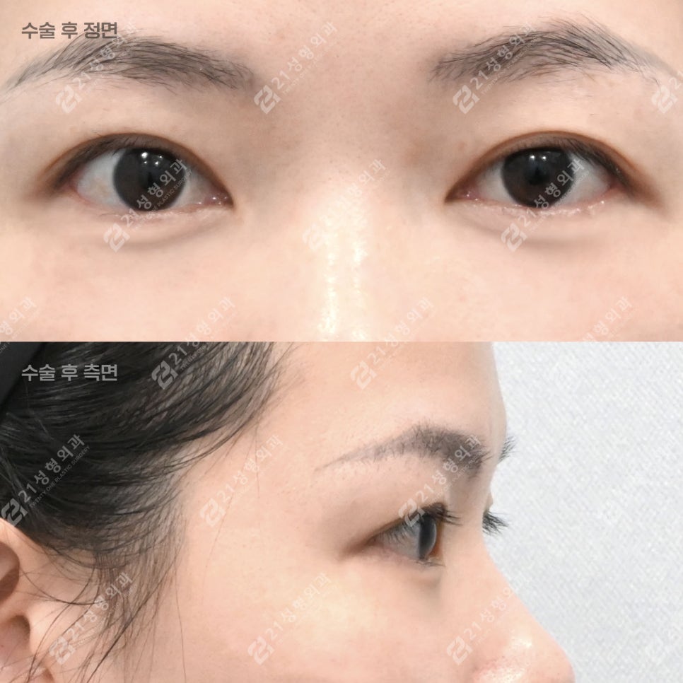 눈밑지방재배치, 30대인데 피곤해 보이는 이유 관련 이미지 2