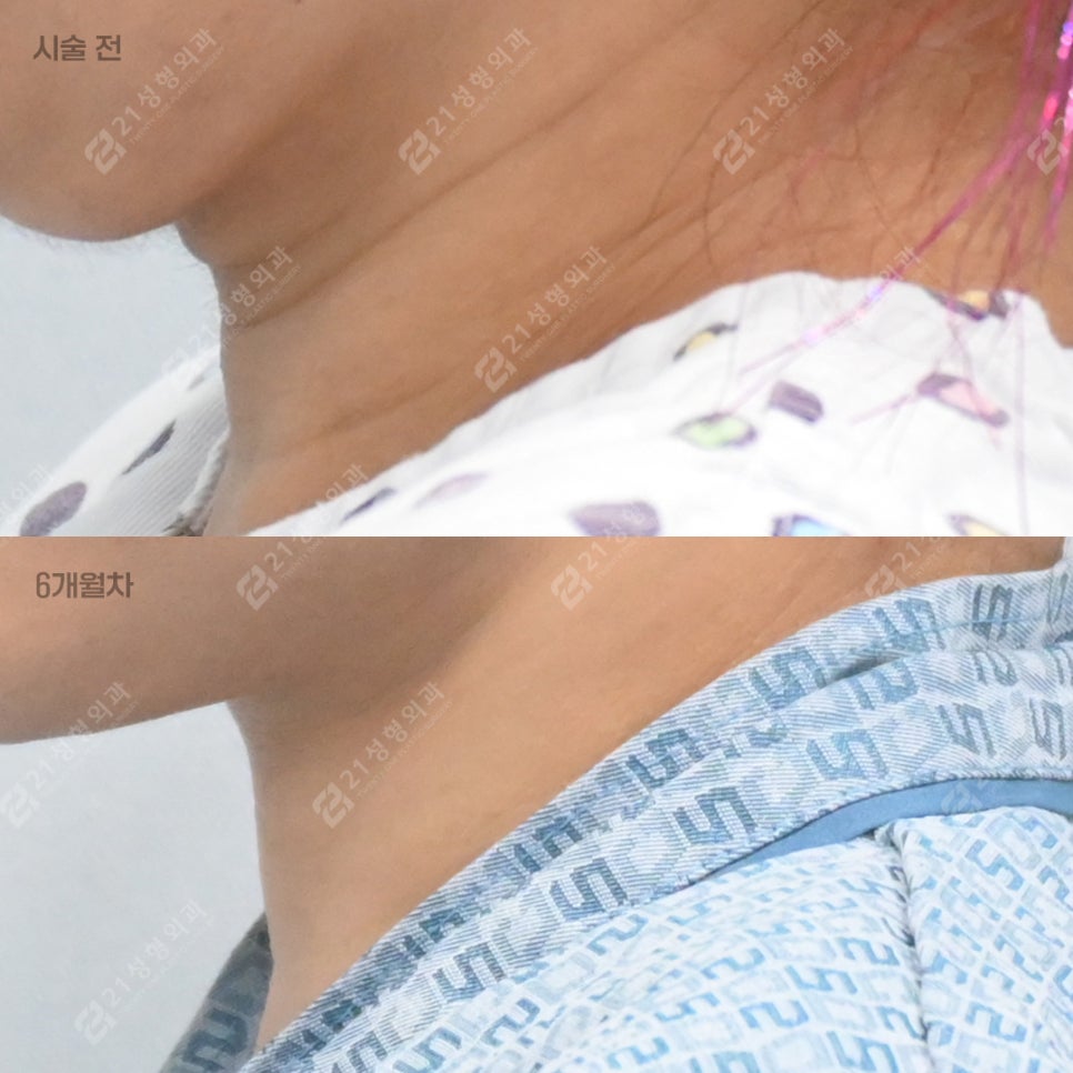 That Posture You Use While Looking at Your Smartphone—Half of Your Neck Wrinkles Start There. — 21 Plastic Surgery Neck Wrinkle Treatment image 4