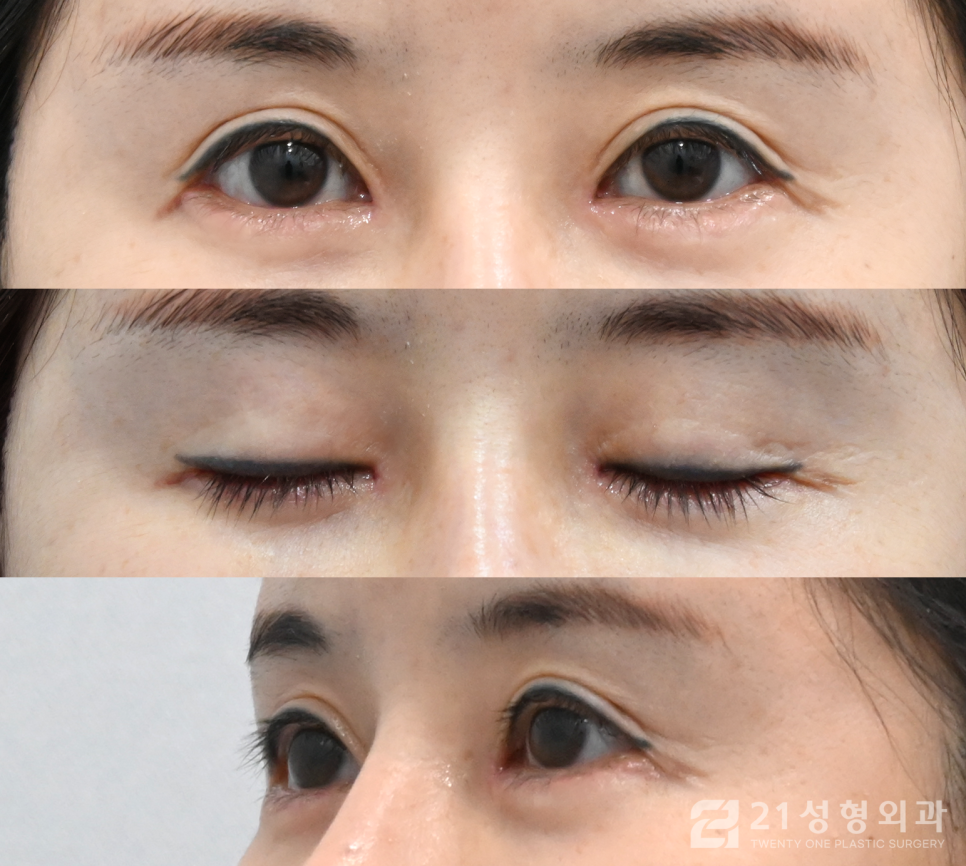 앞트임복원성형외과 잘하는 곳의 특징 관련 이미지 5