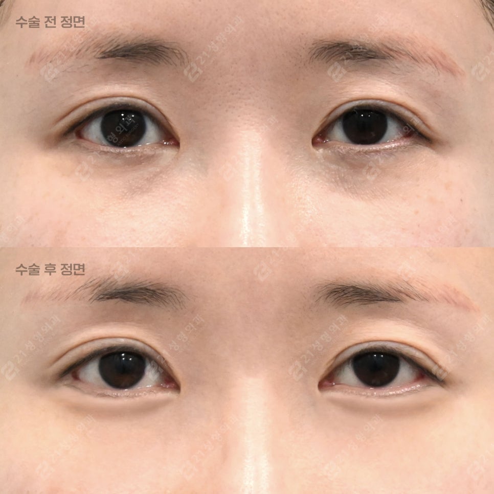 What Is the Secret to Keeping Under-Eye Fat Grafting Beautiful and Natural for a Long Time? image 1