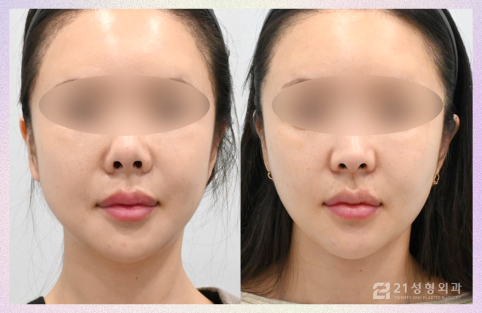 코성형잘하는곳 전체적인 비율을 고려해야 관련 이미지 1