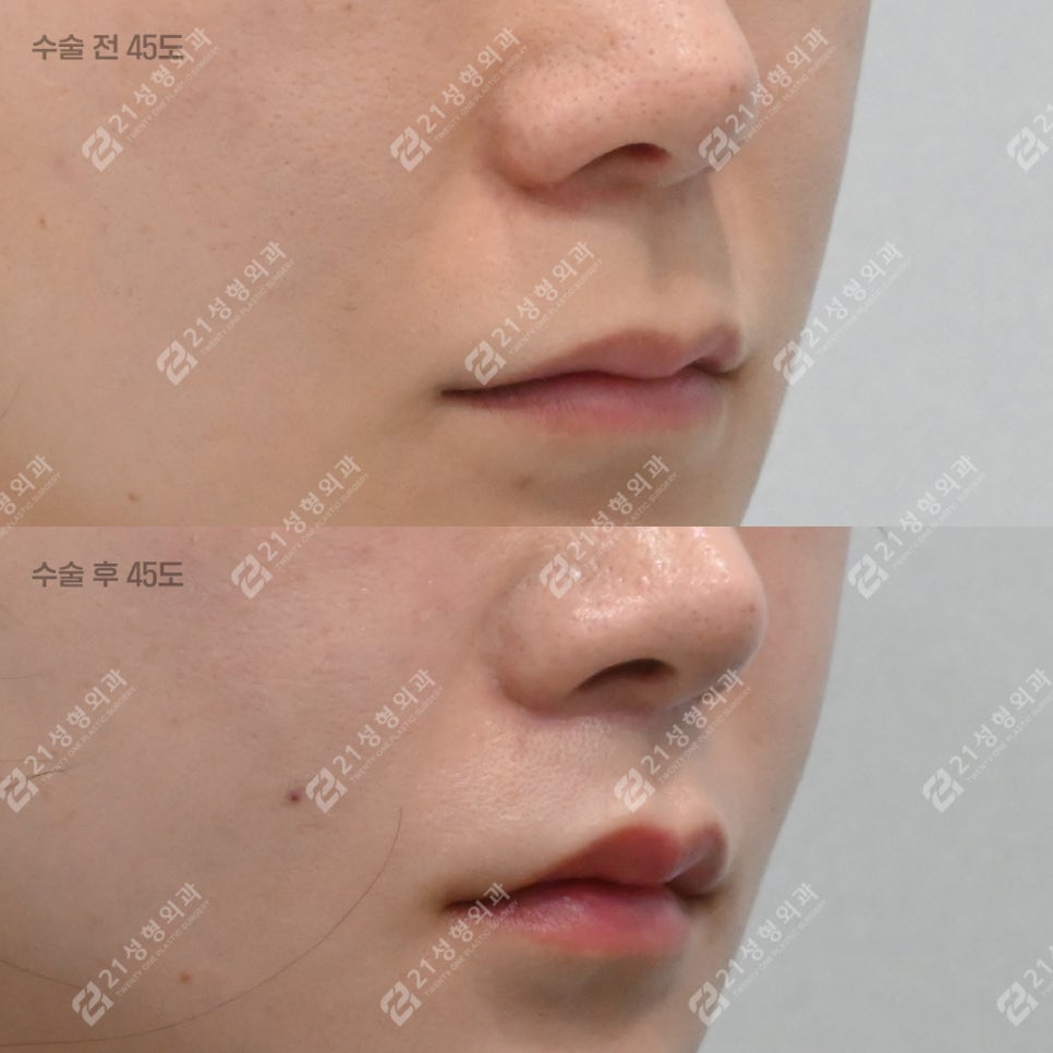What to Check If Your Philtrum Looks Long image 5