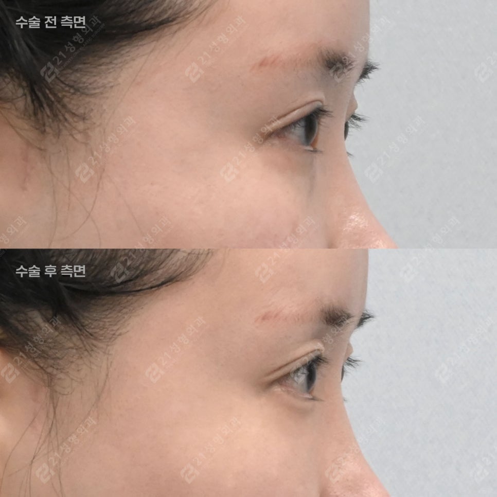 What Is the Secret to Keeping Under-Eye Fat Grafting Beautiful and Natural for a Long Time? image 4