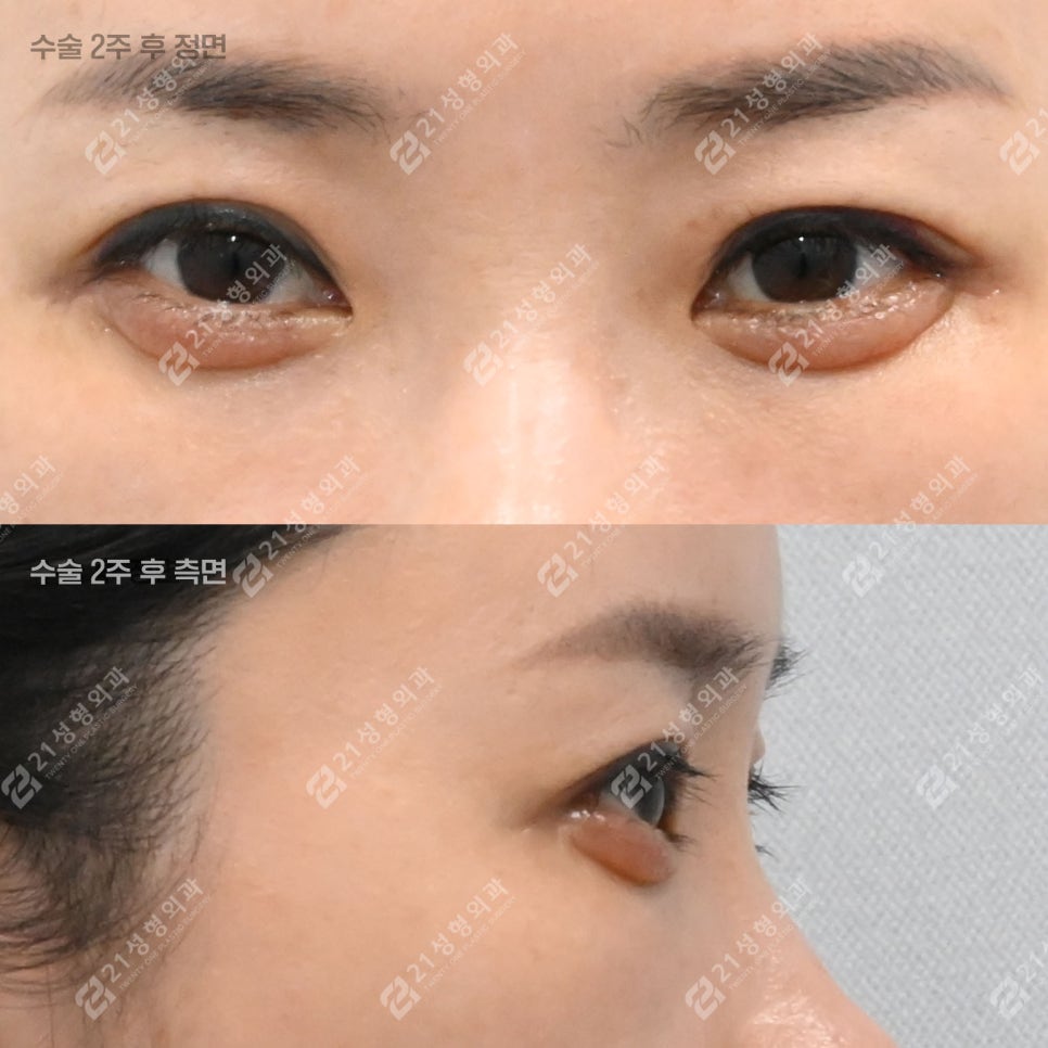 피곤해 보이던 40대 눈밑, 하안검 후 이렇게 달라졌습니다 관련 이미지 3