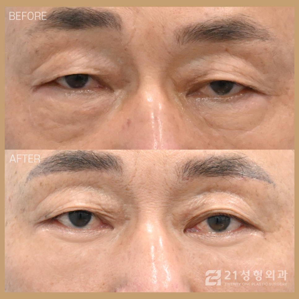 중년눈수술로 꽃중년 소리 들을 수 있습니다 관련 이미지 1