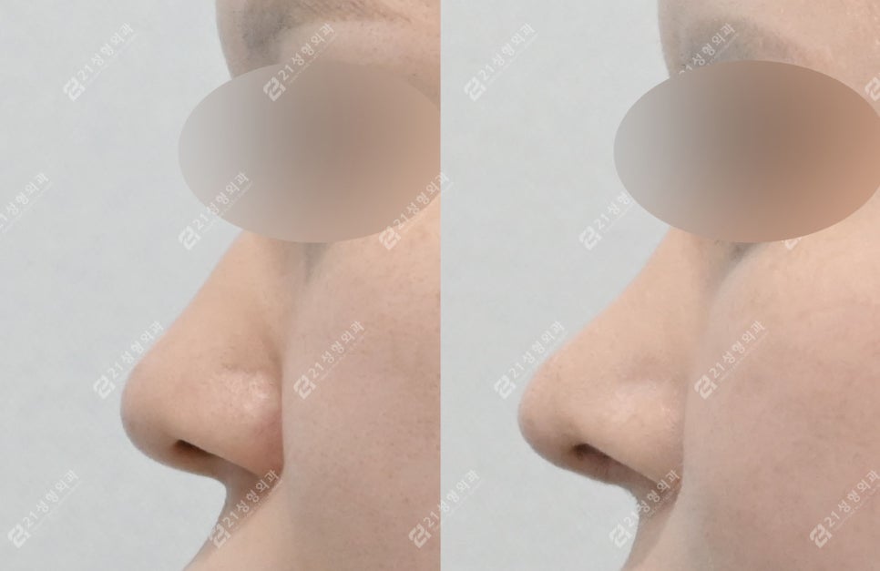 How to Create a Flawless Nose Line | Real Review of Rib Cartilage Rhinoplasty image 8