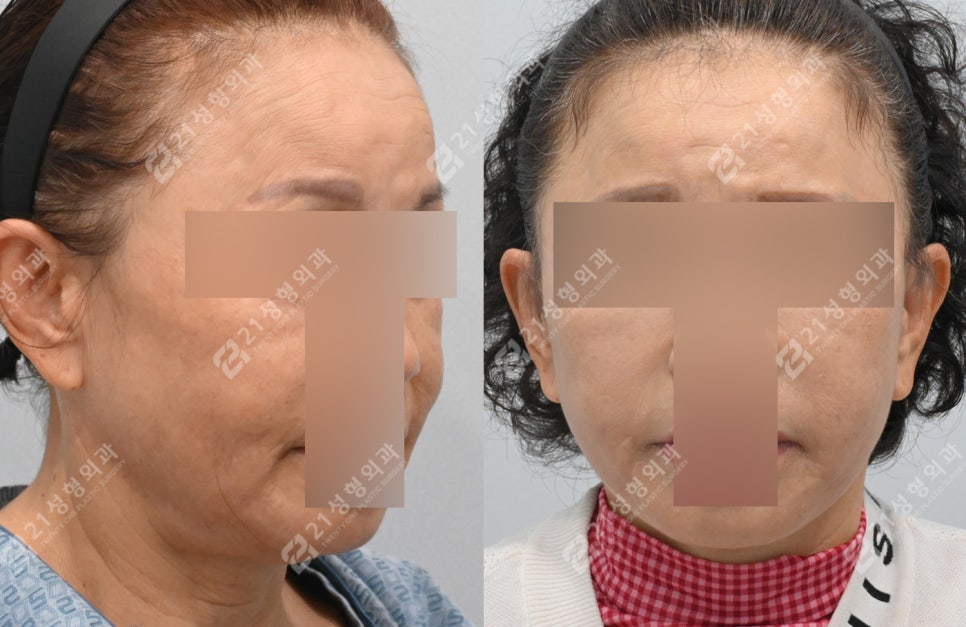 이렇게나 달라져요? 전후 차이 확실한 안면목거상 관련 이미지 5