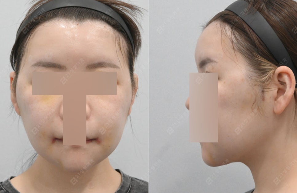 Can I Have a Clean Jawline Too? A Real Review of Double Chin Removal image 3