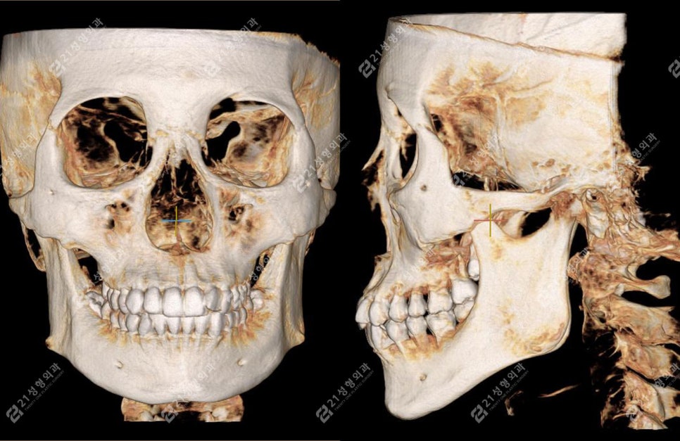 Real Review of Square Jaw Surgery: Square Jaw Surgery Is Not Over After Just Shaving the Bone image 2