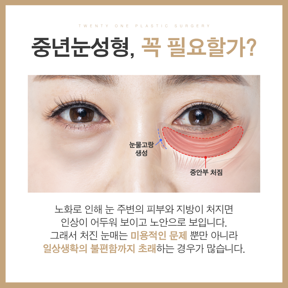 중년눈수술로 꽃중년 소리 들을 수 있습니다 관련 이미지 3