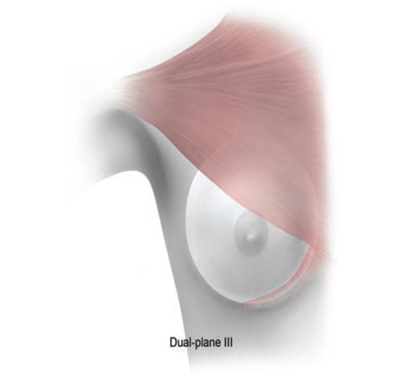 관상형 유방 (Tubular breast) 관련 이미지 10