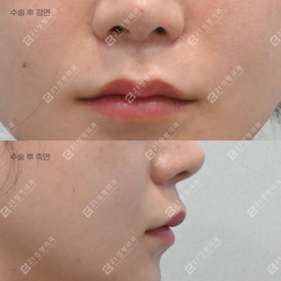 What to Check If Your Philtrum Looks Long image 4