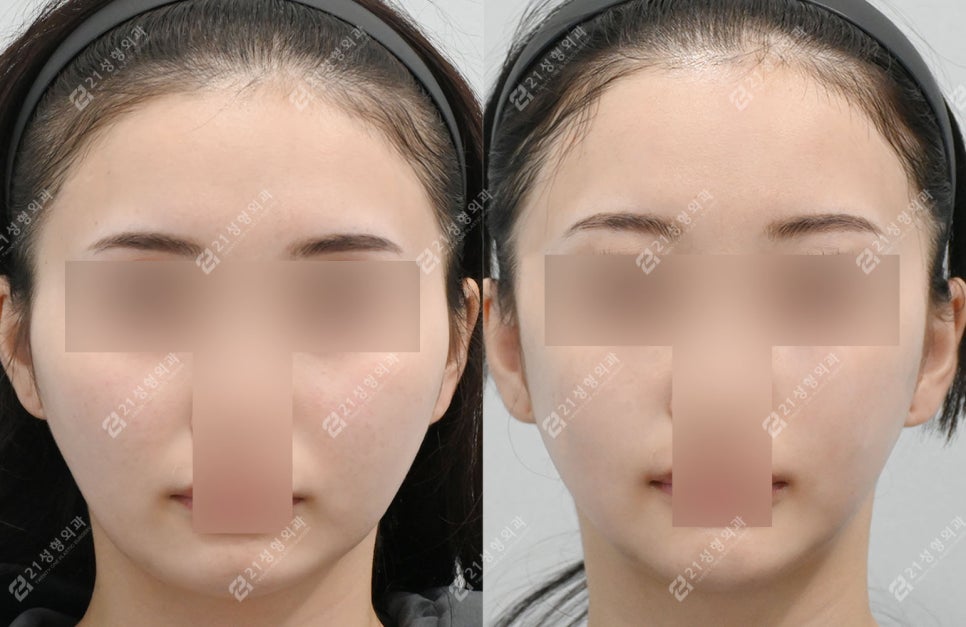 작은 얼굴이지만 윤곽 3종이 필요한 케이스: 턱끝 전진형 얼굴 분석 관련 이미지 1