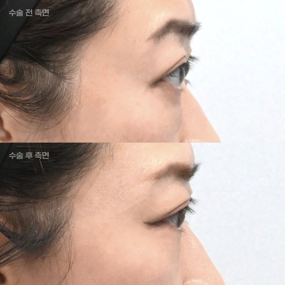 If People Always Tell You That You Look Tired, Could Under-Eye Fat Be the Cause? image 4