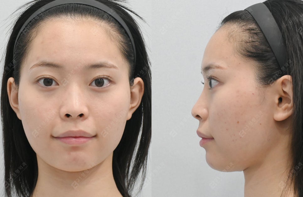 Facial Contouring, Key Points You Must Know: A Real Review of Changes Over 1 Year and 6 Months image 2