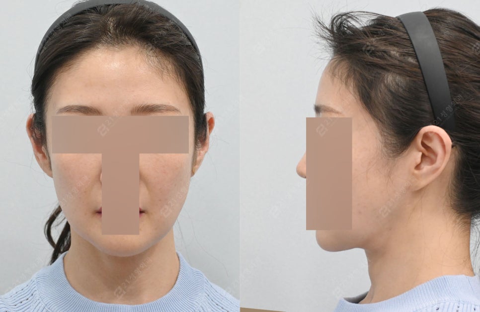 Real Review: A Smooth Improvement of Leftover Double Chin and Jowl Fat Even After Dieting image 6