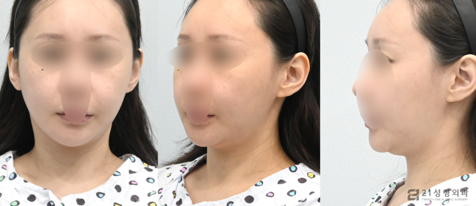 이중턱제거수술, 숨겨진 라인을 찾는 방법 관련 이미지 4